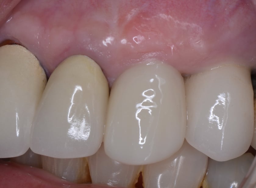 When To Immediately Load an Immediate Implant