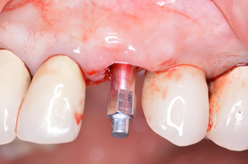 When To Immediately Load An Immediate Implant