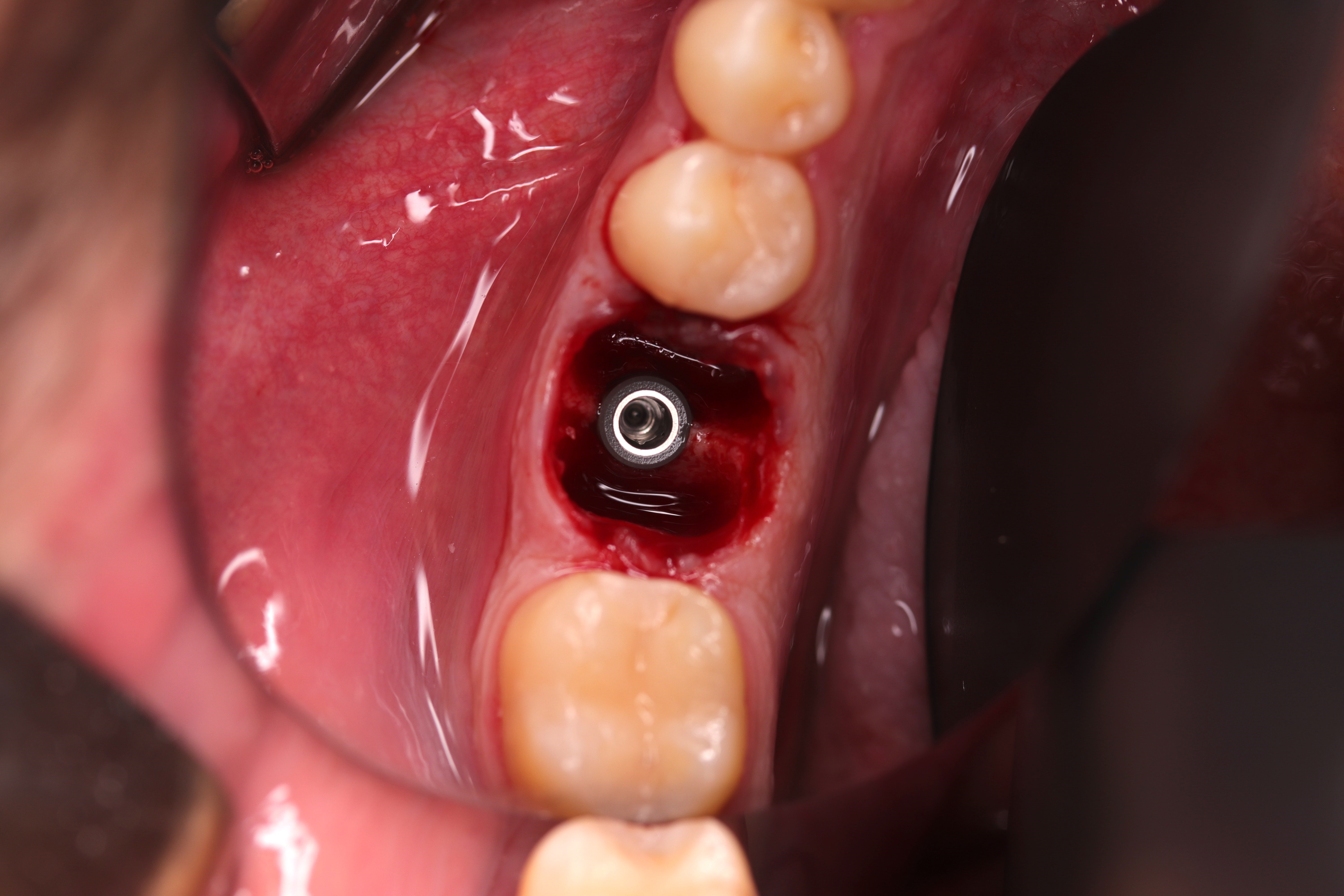 Essential in Oral Implantology: The ISQ value - by Dr Emilio Rodríguez ...